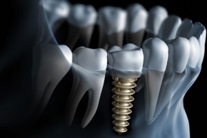 Dental Implant | Family Dental Care