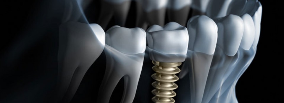 Dental Implant | Family Dental Care