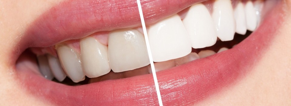Teeth Whitening | Family Dental Care